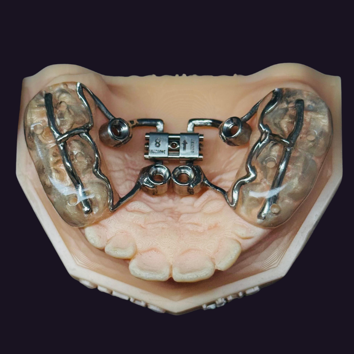 Mini-İmplantlar ve Yönlendirici Yiv